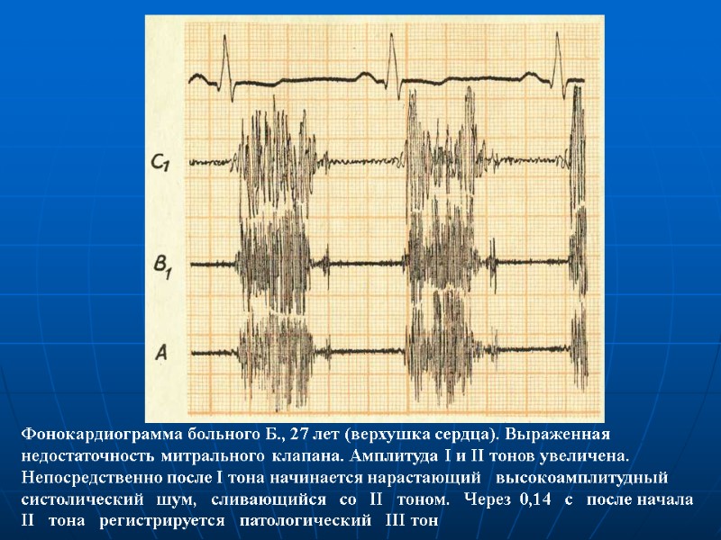 Фонокардиограмма больного Б., 27 лет (верхушка сердца). Выраженная недостаточность митрального Фонокардиограмма больного Б., 27 лет (верхушка сердца). Выраженная недостаточность митрального